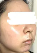 水光注射（ハリ・美肌） ARTE BEAUTY CLINIC AFTER サムネイル用