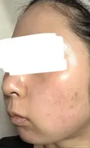 水光注射（ハリ・美肌） ARTE BEAUTY CLINIC DAY 9 サムネイル用