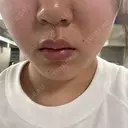 ピーリング（ニキビ・毛穴） / 毛穴洗浄（ハイドラフェイシャルなど） / ポテンツァ Tokyo Tensei Clinic 銀座院 DAY 2 サムネイル用