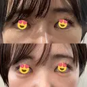 ヒアルロン酸注入（涙袋） / ヒアルロン酸注入（唇） / ボトックス（人中） HAAB×DREAM BEAUTY CLINIC 東京本院 DAY 1 サムネイル用