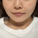 糸リフト / 脂肪吸引（顔） / ヒアルロン酸注入（唇） 仙台TAクリニック AFTER サムネイル用