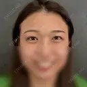 二重埋没 ネビュラクリニック 京都院 AFTER サムネイル用