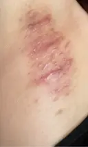 ワキ汗治療（切開） 石倉クリニック 水戸院 DAY 110 サムネイル用