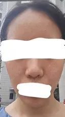 水光注射（ハリ・美肌） RAISE CLINIC 【レイズクリニック】 DAY 0 サムネイル用