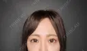 クマ治療 / 下まぶたたるみ取り / ボトックス（あご） / ヒアルロン酸注入（あご） / ヒアルロン酸注入（目の下） / ヒアルロン酸注入（鼻翼基部） / スネコス Tokyo Tensei Clinic 新宿院 DAY 22 サムネイル用