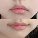 ボトックス（エラ・小顔） / ボトックス（口角） あいちビューティークリニック DAY 7 サムネイル用
