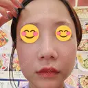 ヒアルロン酸注入（唇） / ルメッカ ルラ美容クリニック 大宮院 / ルラスキンクリニック 大宮院 DAY 9 サムネイル用