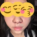 小鼻縮小（切開） / 人中短縮 / 鼻翼挙上 Otus Clinic 【オータスクリニック】 DAY 0 サムネイル用