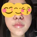 小鼻縮小（切開） / 人中短縮 / 鼻翼挙上 Otus Clinic 【オータスクリニック】 DAY 0 サムネイル用