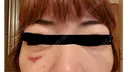 その他（目元） / クマ治療 / 上まぶたの脂肪取り / ヒアルロン酸注入（目の下） ROOTS Clinic DAY 9 サムネイル用