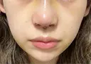 隆鼻術 / 鼻尖形成（切開） / 鼻中隔延長（切開） / 軟骨移植 / 鼻孔縁挙上 / 鼻尖縮小 X CLINIC 大阪院 DAY 5 サムネイル用