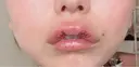 その他（口元） アネシス美容クリニック DAY 4 サムネイル用