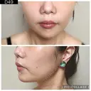 糸リフト PRISM Beauty Clinic 町田院 DAY 49 サムネイル用