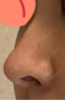 鼻尖形成（切開） / 骨削り（頬） / 軟骨移植 / 鼻孔縁挙上 THE ROPPONGI CLINIC（ザ 六本木クリニック） DAY 91 サムネイル用