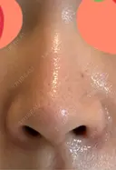 鼻尖形成（切開） / 骨削り（頬） / 軟骨移植 / 鼻孔縁挙上 THE ROPPONGI CLINIC（ザ 六本木クリニック） DAY 91 サムネイル用