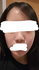 水光注射（ハリ・美肌） RAISE CLINIC 【レイズクリニック】 DAY 1 サムネイル用