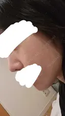 水光注射（ハリ・美肌） RAISE CLINIC 【レイズクリニック】 DAY 1 サムネイル用