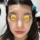 鼻尖形成（切開） / 鼻中隔延長（切開） / 脂肪溶解注射 / ボトックス（肩） / その他（鼻） エートップ美容整形外科 DAY 11 サムネイル用