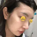 鼻尖形成（切開） / 鼻中隔延長（切開） / 脂肪溶解注射 / ボトックス（肩） / その他（鼻） エートップ美容整形外科 DAY 11 サムネイル用