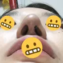 鼻尖形成（切開） / 鼻中隔延長（切開） / 脂肪溶解注射 / ボトックス（肩） / その他（鼻） エートップ美容整形外科 DAY 11 サムネイル用