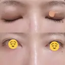 二重埋没 / 上まぶたの脂肪取り THE FIRST CLINIC 多摩センター院 AFTER サムネイル用