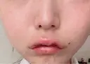 その他（口元） アネシス美容クリニック DAY 6 サムネイル用