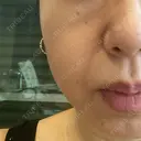 糸リフト BAO CLINIC 梅田院 DAY 7 サムネイル用