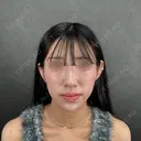 二重埋没 / 目頭切開 / 糸リフト / 脂肪吸引（顔） / ヒアルロン酸注入（涙袋） / ヒアルロン酸注入（あご） / ボトックス（エラ・小顔） / ボトックス（人中） ネビュラクリニック 京都院 AFTER サムネイル用