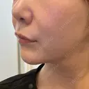 ヒアルロン酸注入（涙袋） / ヒアルロン酸注入（唇） / ボトックス（人中） HAAB×DREAM BEAUTY CLINIC 東京本院 AFTER サムネイル用