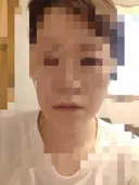 ボトックス（エラ・小顔） PRISM Beauty Clinic 町田院 DAY 2 サムネイル用