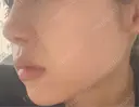 隆鼻術 / 鼻尖形成（切開） / 鼻中隔延長（切開） / 軟骨移植 / 鼻孔縁挙上 / 鼻尖縮小 X CLINIC 大阪院 DAY 9 サムネイル用