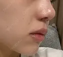 隆鼻術 / 鼻尖形成（切開） / 鼻中隔延長（切開） / 軟骨移植 / 鼻孔縁挙上 / 鼻尖縮小 X CLINIC 大阪院 DAY 11 サムネイル用
