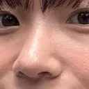 小鼻縮小（切開） / 鼻尖形成（非切開） ASTRA BEAUTY CLINIC DAY 638 サムネイル用