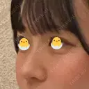 小鼻縮小（切開） / 鼻尖形成（非切開） ASTRA BEAUTY CLINIC DAY 638 サムネイル用