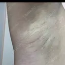 ワキ汗治療（レーザー） Fellez Clinic【フェルズクリニック】 DAY 56 サムネイル用