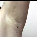ワキ汗治療（レーザー） Fellez Clinic【フェルズクリニック】 DAY 56 サムネイル用