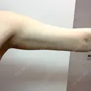 ワキ汗治療（レーザー） Fellez Clinic【フェルズクリニック】 DAY 56 サムネイル用