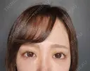 クマ治療 / 下まぶたたるみ取り / ボトックス（あご） / ヒアルロン酸注入（あご） / ヒアルロン酸注入（目の下） / ヒアルロン酸注入（鼻翼基部） / スネコス Tokyo Tensei Clinic 新宿院 AFTER サムネイル用