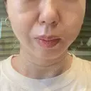 糸リフト BAO CLINIC 梅田院 DAY 8 サムネイル用