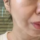 糸リフト BAO CLINIC 梅田院 DAY 8 サムネイル用