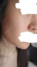 水光注射（ハリ・美肌） RAISE CLINIC 【レイズクリニック】 DAY 2 サムネイル用