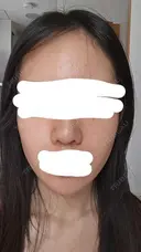 水光注射（ハリ・美肌） RAISE CLINIC 【レイズクリニック】 DAY 2 サムネイル用