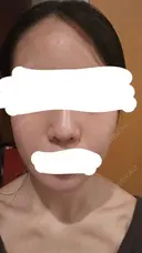 水光注射（ハリ・美肌） RAISE CLINIC 【レイズクリニック】 DAY 3 サムネイル用