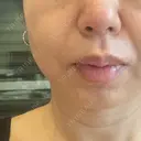 糸リフト BAO CLINIC 梅田院 DAY 9 サムネイル用