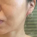 糸リフト BAO CLINIC 梅田院 DAY 9 サムネイル用