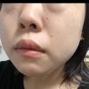 エレクトロポレーション / ルメッカ B-LINE CLINIC 池袋院 DAY 10 サムネイル用
