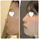 隆鼻術 / 鼻尖形成（切開） / 小鼻縮小（切開） / 軟骨移植 / 鼻柱下降・鼻唇角形成（猫手術） / ボトックス（エラ・小顔） / 毛穴洗浄（ハイドラフェイシャルなど） グローバルビューティークリニック 大阪院 DAY 119 サムネイル用