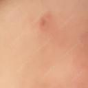ほくろ・いぼ切除（肌） Belle Via Skin Clinic DAY 8 サムネイル用