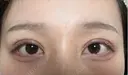 二重埋没 BELINDA CLINIC（ベリンダクリニック）新宿院 DAY 24 サムネイル用