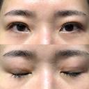 二重埋没 / クマ治療 / 上まぶたの脂肪取り / 下まぶたの脂肪取り NARU Beauty Clinic 【ナルクリ】 DAY 29 サムネイル用